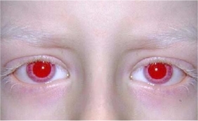 ocular albinism