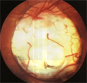 eye scan of coloboma