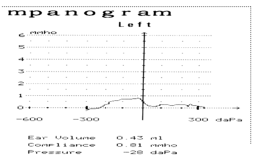 tympanogram