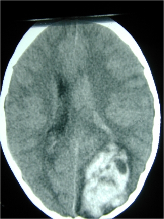 homonymous hemianopia