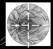 optic nerve involvement