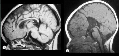 septo optic dysplasia